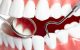 Misfarging av tenner
